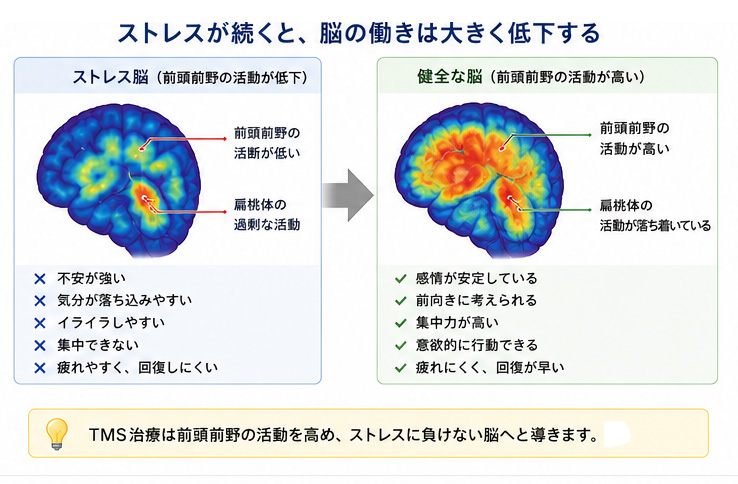 TMS治療の効果